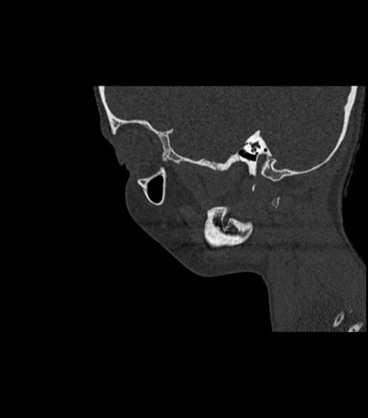 File:Nasoorbitoethmoid fracture (Radiopaedia 90044-107205 Sagittal bone window 40).jpg