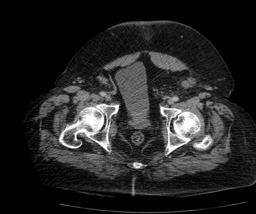 Nephroptosis with inguinal hernia containing perirenal fat (Radiopaedia 56632-63391 C 313).jpg