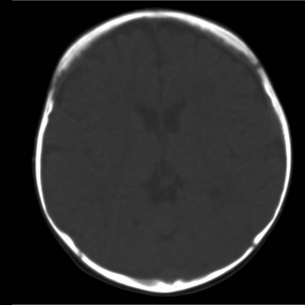 File:Neuroblastoma with skull metastases (Radiopaedia 30326-30958 Axial bone window 11).jpg