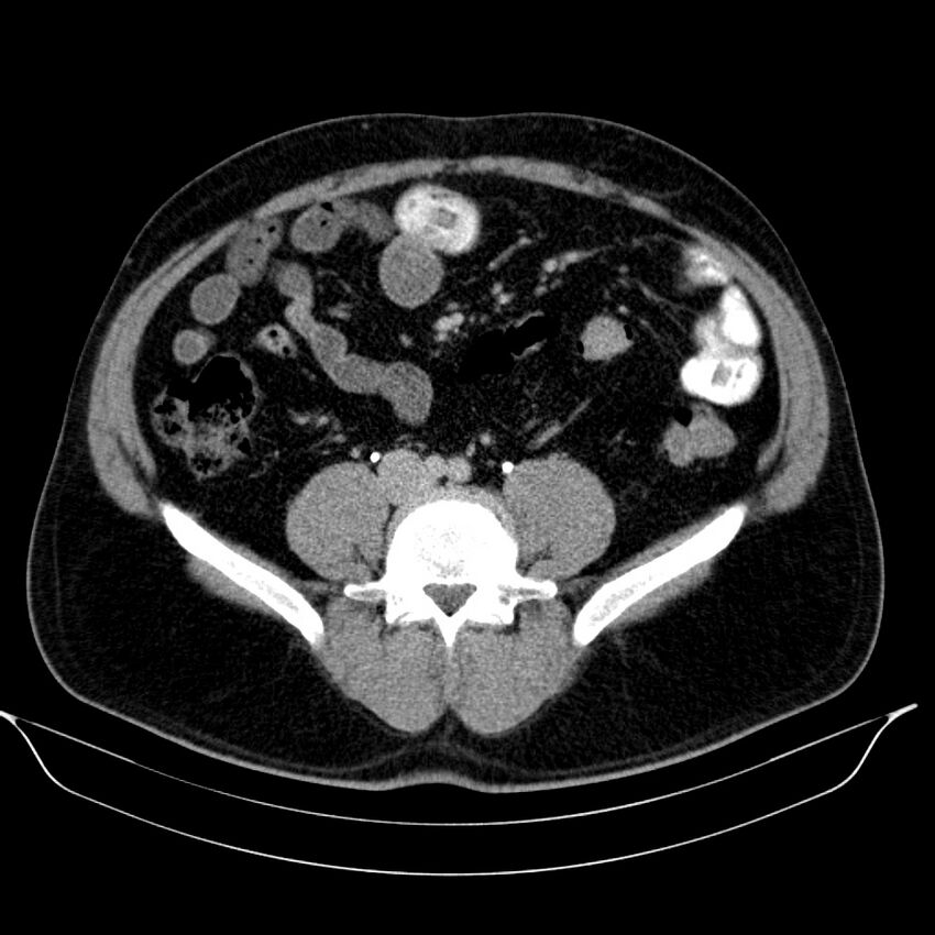 Neuroendocrine tumor of head of pancreas (Radiopaedia 57538-64502 D 54).jpg