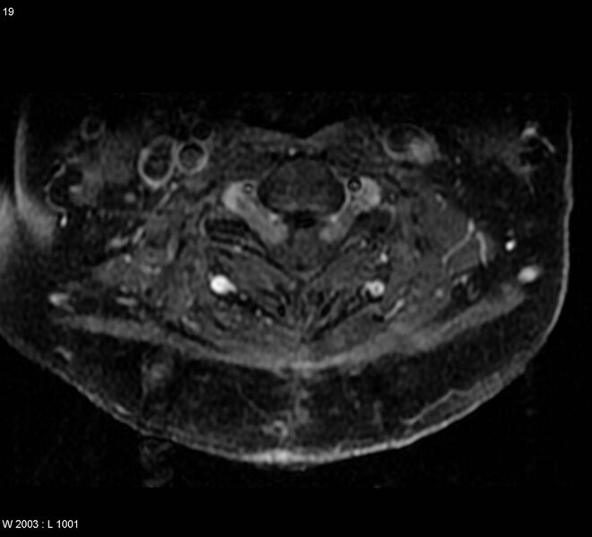 File:Neurofibromatosis type 1 (Radiopaedia 4136-6570 Axial T1 C+ fat sat 1).jpg