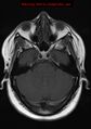 Neuroglial cyst (Radiopaedia 10713-11184 Axial T1 17).jpg