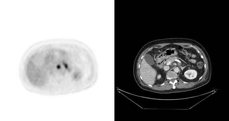 File:Non-Hodgkin lymphoma involving seminal vesicles with development of interstitial pneumonitis during Rituximab therapy (Radiopaedia 32703-33675 axial PET CT 33).jpg
