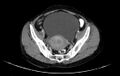 Non-puerperal uterine inversion (Radiopaedia 78343-91094 A 10).jpg
