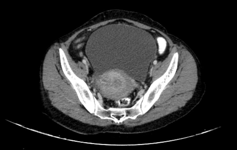 File:Non-puerperal uterine inversion (Radiopaedia 78343-91094 A 10).jpg