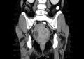 Non-puerperal uterine inversion (Radiopaedia 78343-91094 B 37).jpg