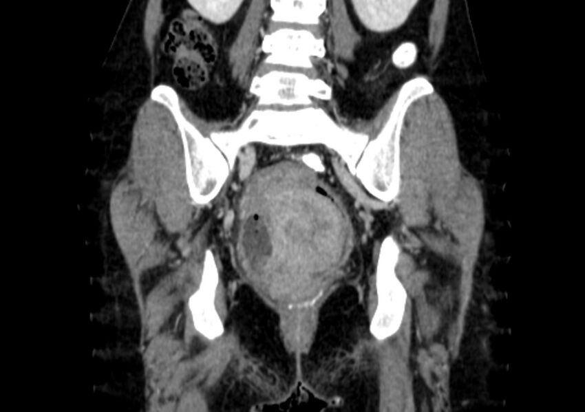 Non-puerperal uterine inversion (Radiopaedia 78343-91094 B 37).jpg