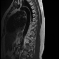 Normal cervical and thoracic spine MRI (Radiopaedia 35630-37156 I 2).png