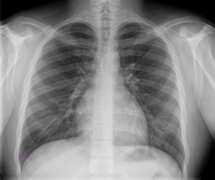 File:Normal chest x-ray - lobes (illustration) (Radiopaedia 58938-66192 L 1).png
