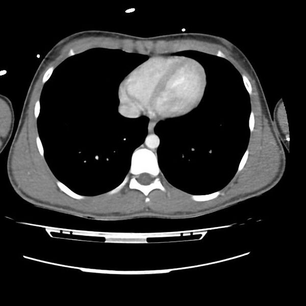 File:Normal dual-phase trauma CT chest,abdomen and pelvis (Radiopaedia 48092-52899 A 39).jpg