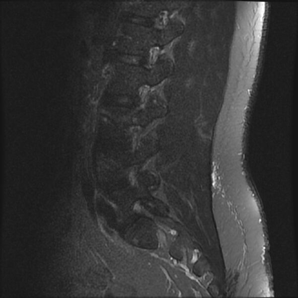 File:Normal lumbar spine MRI (Radiopaedia 43051-46311 Sagittal STIR 6).jpg