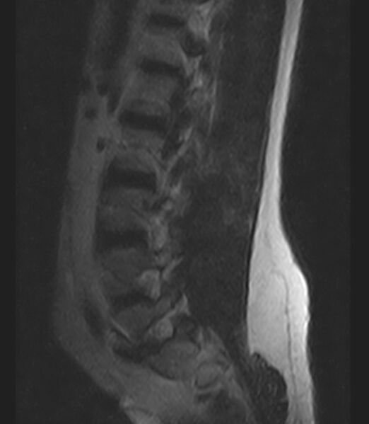 File:Normal lumbar spine MRI - low-field MRI scanner (Radiopaedia 40976-43699 Sagittal T2 10).jpg