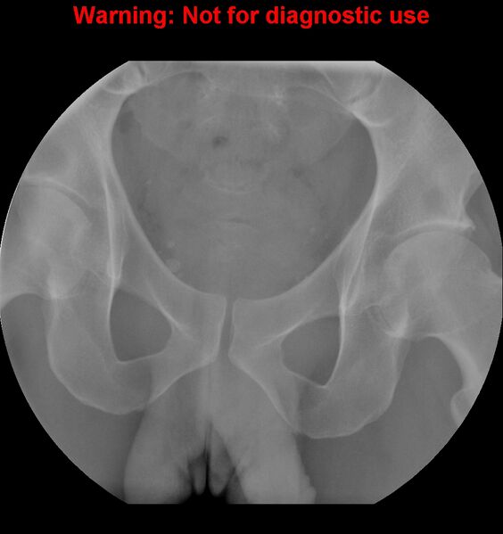 File:Normal retrograde urethrogram (RUG) and voiding cystourethrogram (VCUG) (Radiopaedia 40478-43050 RUG 2).jpg