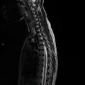 Normal spine MRI (Radiopaedia 77323-89408 E 5).jpg