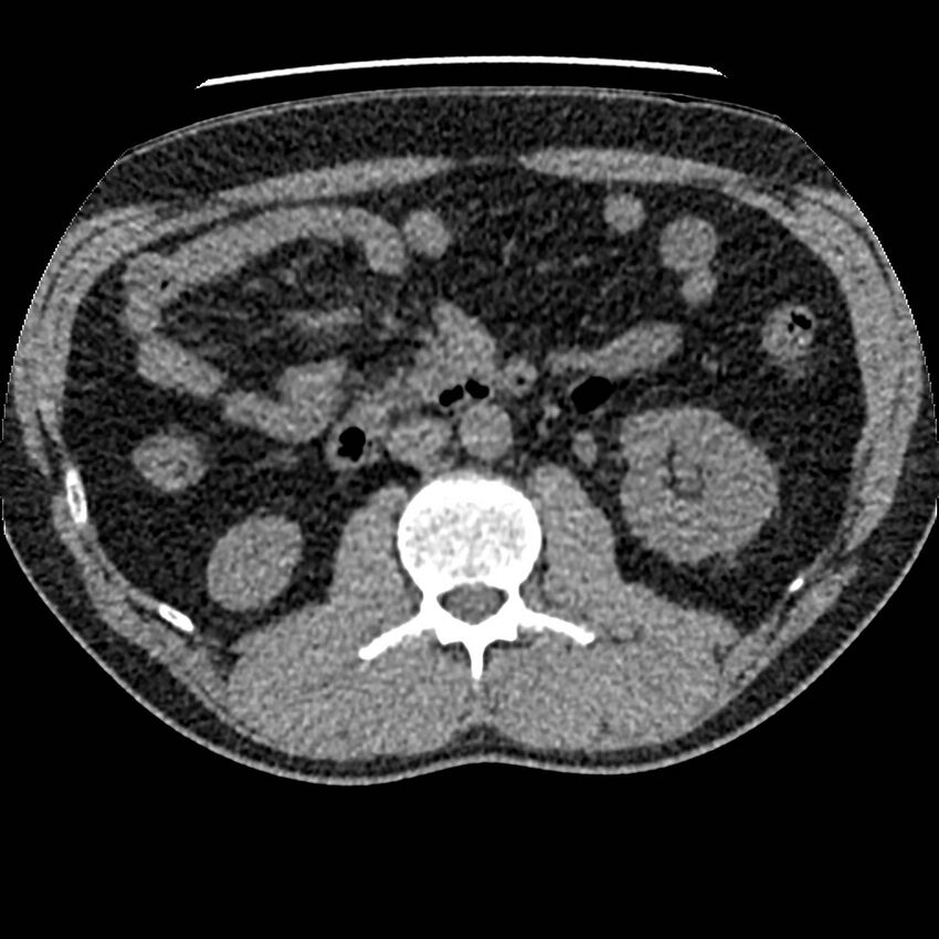 Obstructing ureteric calculus and ureteric anatomy (Radiopaedia 62730-71042 Axial non-contrast 51).jpg