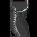 Occipital condyle fracture (Radiopaedia 18366-18208 Sagittal bone window 11).jpg