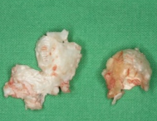 Dissected friable cholesteatoma with a thin pearly-white greasy-looking wall containing pultaceous substance