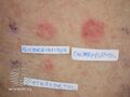 Positive patch test to topical corticosteroids (DermNet NZ dermatitis-corticosteroid-patch).jpg