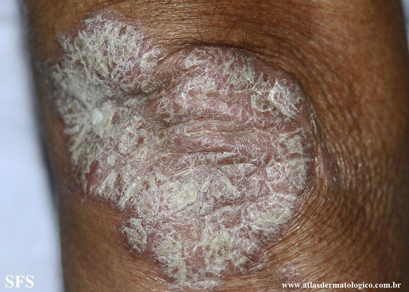File:Psoriasis (Dermatology Atlas 162).jpg