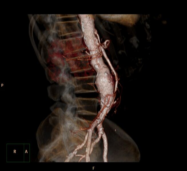 File:Abdominal aortic aneurysm (Radiopaedia 23703-23856 3D 6).jpg