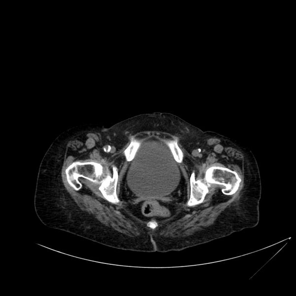 File:Abdominal aortic aneurysm - impending rupture (Radiopaedia 19233-19246 Axial non-contrast 123).jpg
