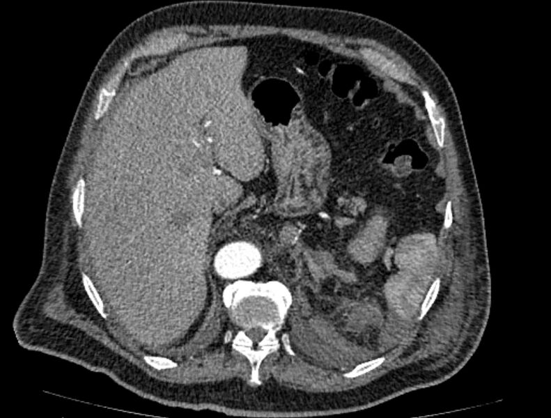 File:Abdominal aortic aneurysm rupture (Radiopaedia 54179-60362 Axial C+ arterial phase 21).jpg