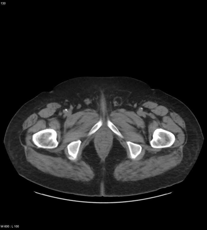 Abdominal aortic aneurysm with intramural hematoma then rupture (Radiopaedia 50278-55631 Axial non-contrast 126).jpg