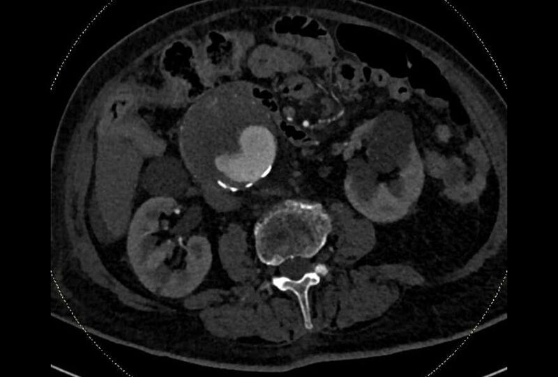 File:Abdominal aortic aneurysm with thrombus fissuration (Radiopaedia 73192-83919 Axial C+ arterial phase 93).jpg
