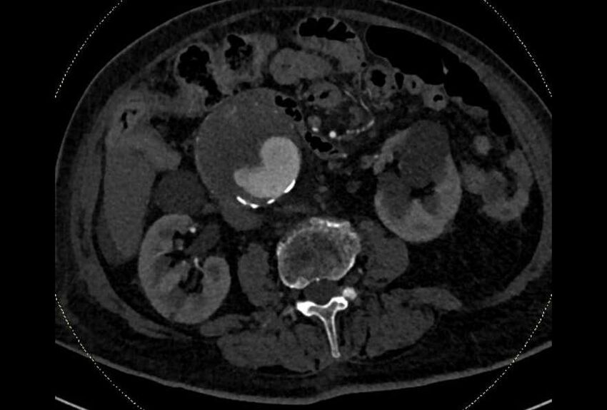 Abdominal aortic aneurysm with thrombus fissuration (Radiopaedia 73192-83919 Axial C+ arterial phase 93).jpg