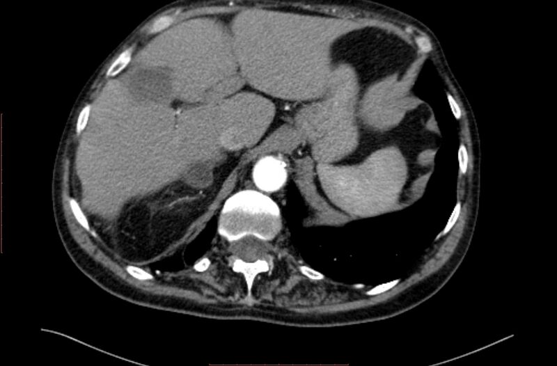 File:Abdominal aortic interposition tube graft and aneurysm thrombosis (Radiopaedia 71438-81857 Axial C+ arterial phase 2).jpg