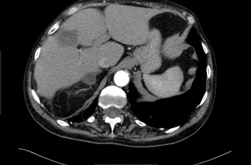 Abdominal aortic interposition tube graft and aneurysm thrombosis (Radiopaedia 71438-81857 Axial C+ arterial phase 2).jpg