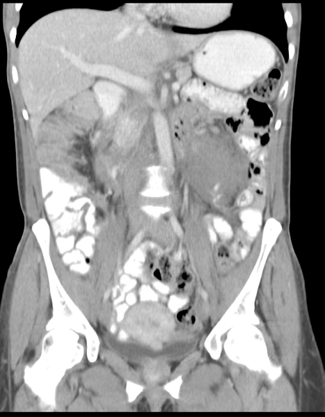 File:Abdominal desmoid tumor (Radiopaedia 41007-43740 Coronal C+ portal venous phase 19).png