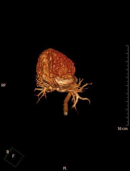 File:Aberrant left pulmonary artery (pulmonary sling) (Radiopaedia 42323-45435 3D reconstruction C+ CTPA 8).jpg