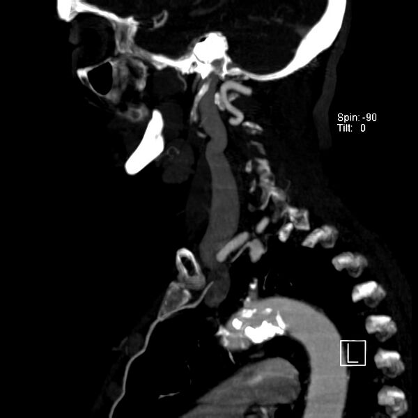 File:Aberrant right subclavian artery (Radiopaedia 22395-22430 Sagittal C+ arterial phase 2).jpg