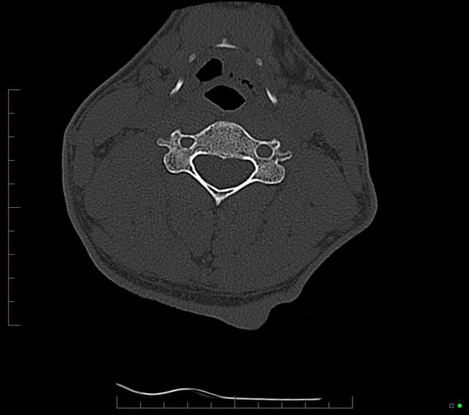 File:Accessory articulation of cervical transverse processes (Radiopaedia 82715-96933 Axial non-contrast 68).jpg