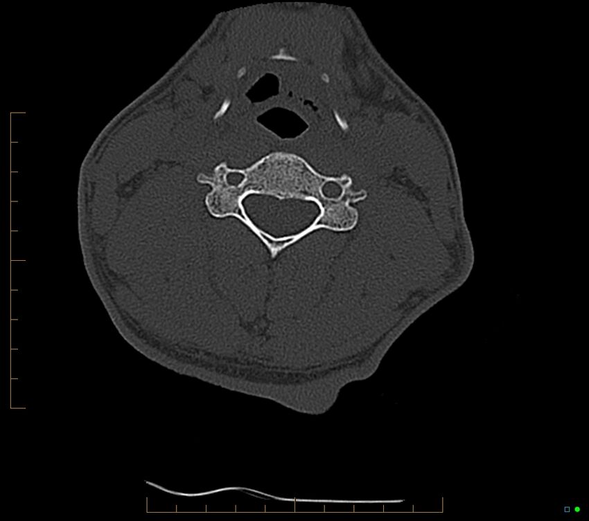 Accessory articulation of cervical transverse processes (Radiopaedia 82715-96933 Axial non-contrast 68).jpg