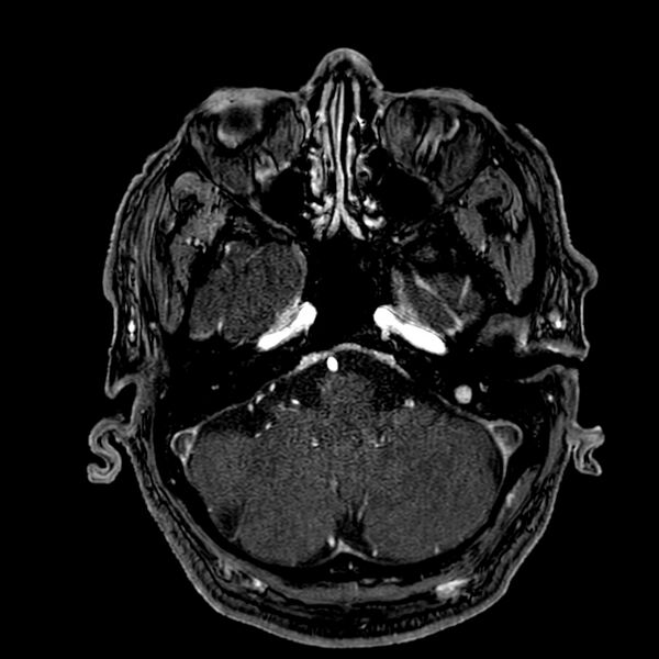 File:Accessory middle cerebral artery (Radiopaedia 73114-83828 Axial MRA 30).jpg