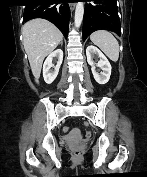 File:Active Crohn disease (Radiopaedia 59394-66750 Coronal C+ portal venous phase 48).jpg