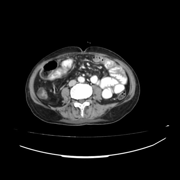 File:Acute-on-chronic Crohn disease with enteroenteric fistula (Radiopaedia 66686-75987 B 12).jpg