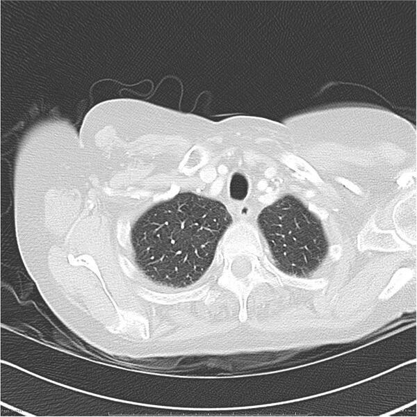 File:Acute-on-chronic pulmonary emboli (Radiopaedia 27925-28169 lung window 5).jpg