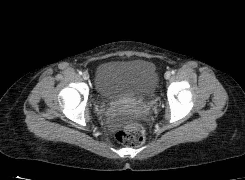 File:Acute Budd-Chiari syndrome (Radiopaedia 60858-68638 Axial C+ portal venous phase 275).jpg