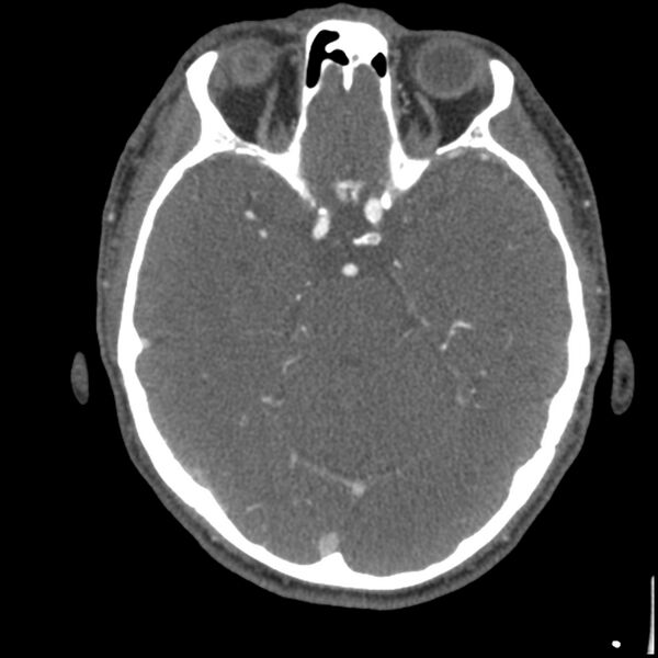 File:Acute P1 occlusion with PCA ischemia penumbra (CT perfusion) (Radiopaedia 72084-82587 Axial C+ arterial thins 53).jpg