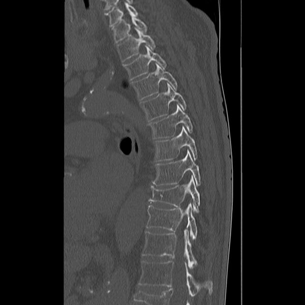 File:Acute and chronic vertebral compression fractures (Radiopaedia 31608-32494 Sagittal bone window 19).jpg
