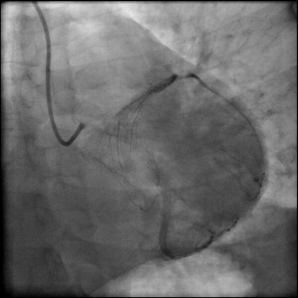 File:Acute anteroseptal myocardial infarction (Radiopaedia 68409-77946 LAO caudal (spider view) LAD and CX 57).jpg