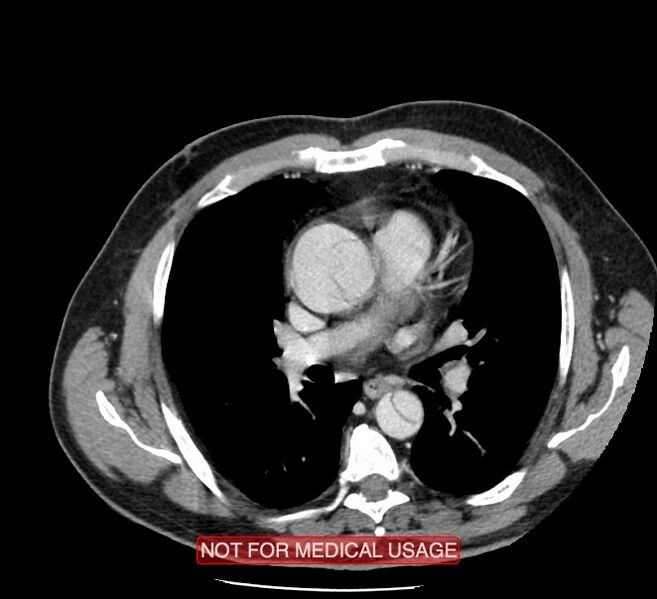 File:Acute aortic dissection - Stanford type A (Radiopaedia 40661-43285 Axial C+ portal venous phase 24).jpg