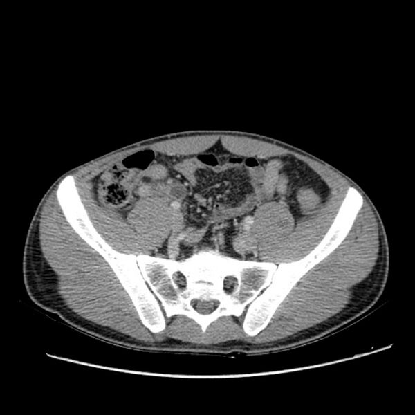 File:Acute appendicitis (Radiopaedia 27049-27227 Axial C+ portal venous phase 56).jpg