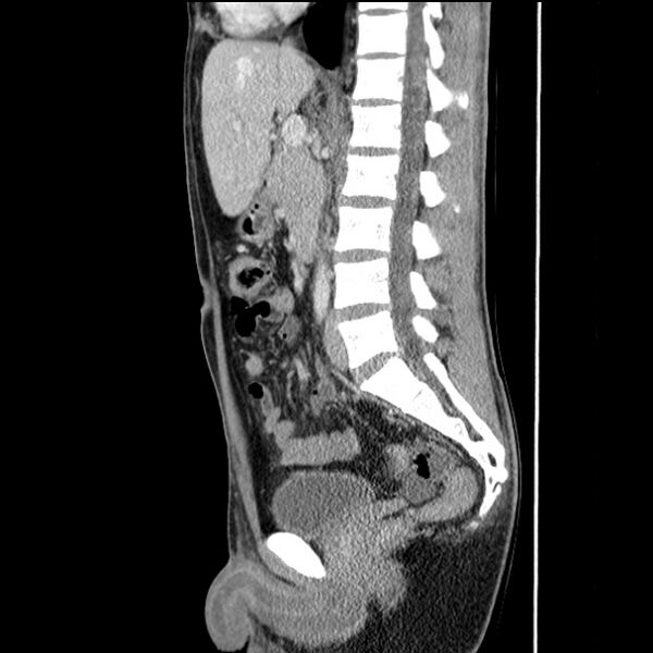 File:Acute appendicitis (Radiopaedia 27049-27227 Sagittal C+ portal venous phase 41).jpg