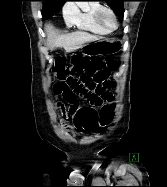File:Acute arterial mesenteric ischemia (Radiopaedia 78238-90828 Coronal C+ portal venous phase 25).jpg