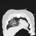 Acute aspiration pneumonitis (Radiopaedia 33605-34703 Coronal lung window 16).jpg