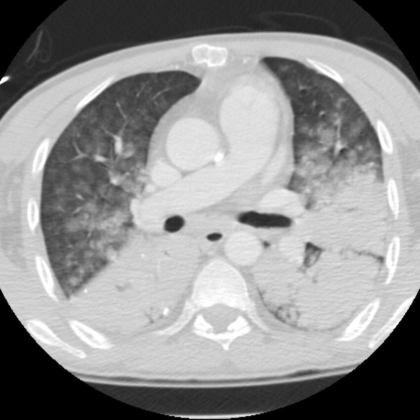 Acute diffuse alveolar hemorrhage (Radiopaedia 41323-44158 Axial lung window 26).jpg